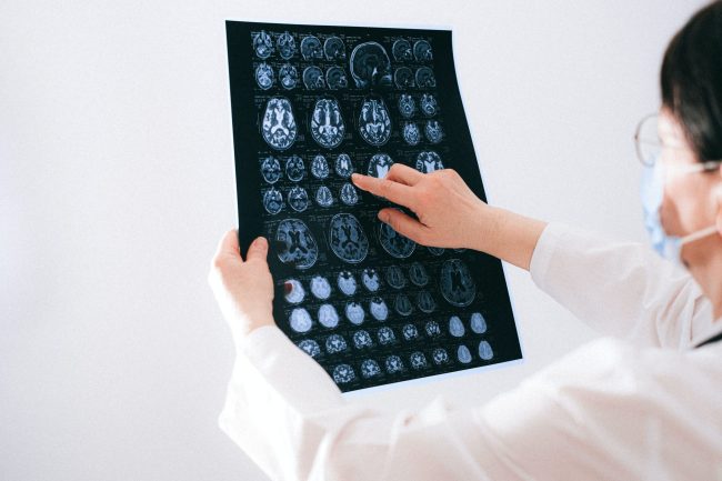 tartamudez cerebro