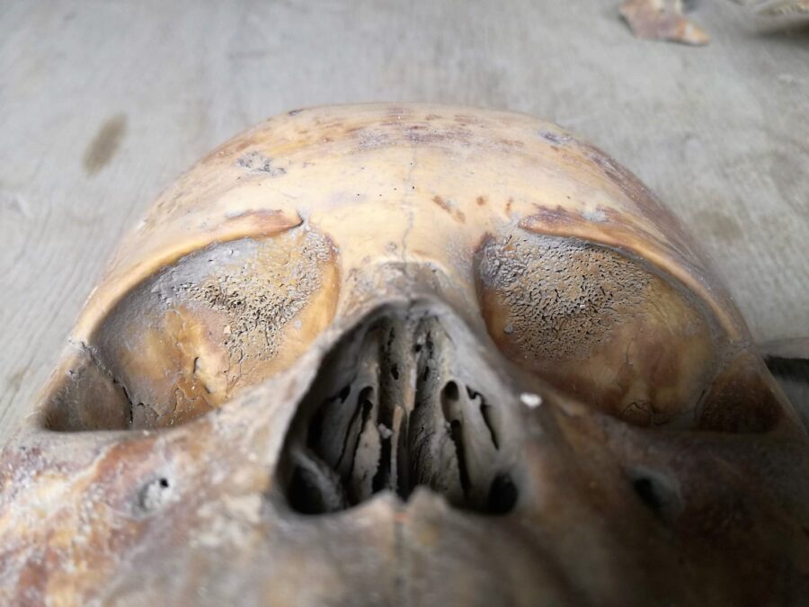 Detalle de patología en cráneo – Foto Juan Carlos Campos Varela. DSA INAH