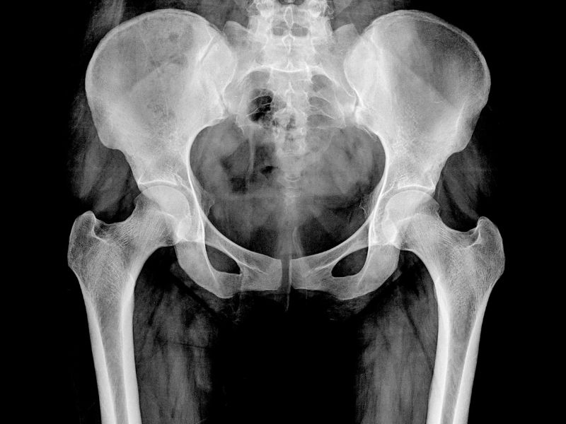 osteoporosis-tc