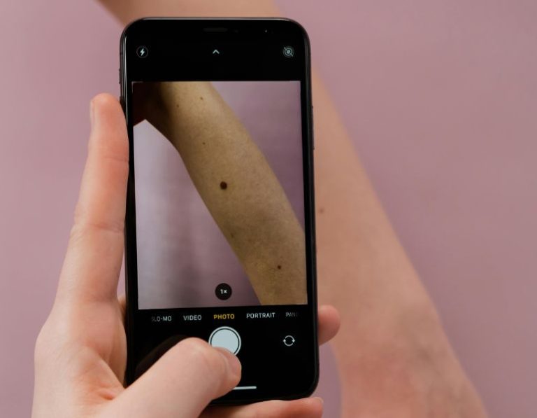 cáncer de piel melanoma Europa IA escáner
