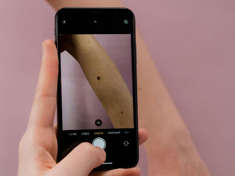 cáncer de piel melanoma Europa IA escáner