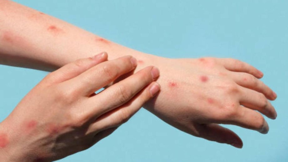 Viruela Símica MPOX África